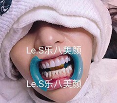 天津Le.S乐八·牙齿美白臻瓷美牙学校轮播1